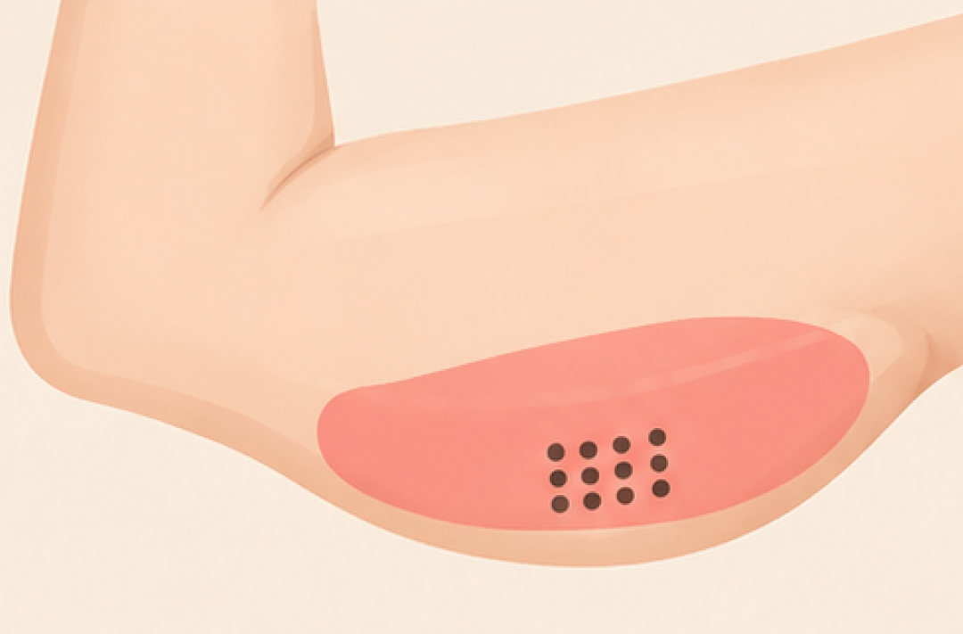 팔뚝 시술 부위를 점으로 표시한 그림
