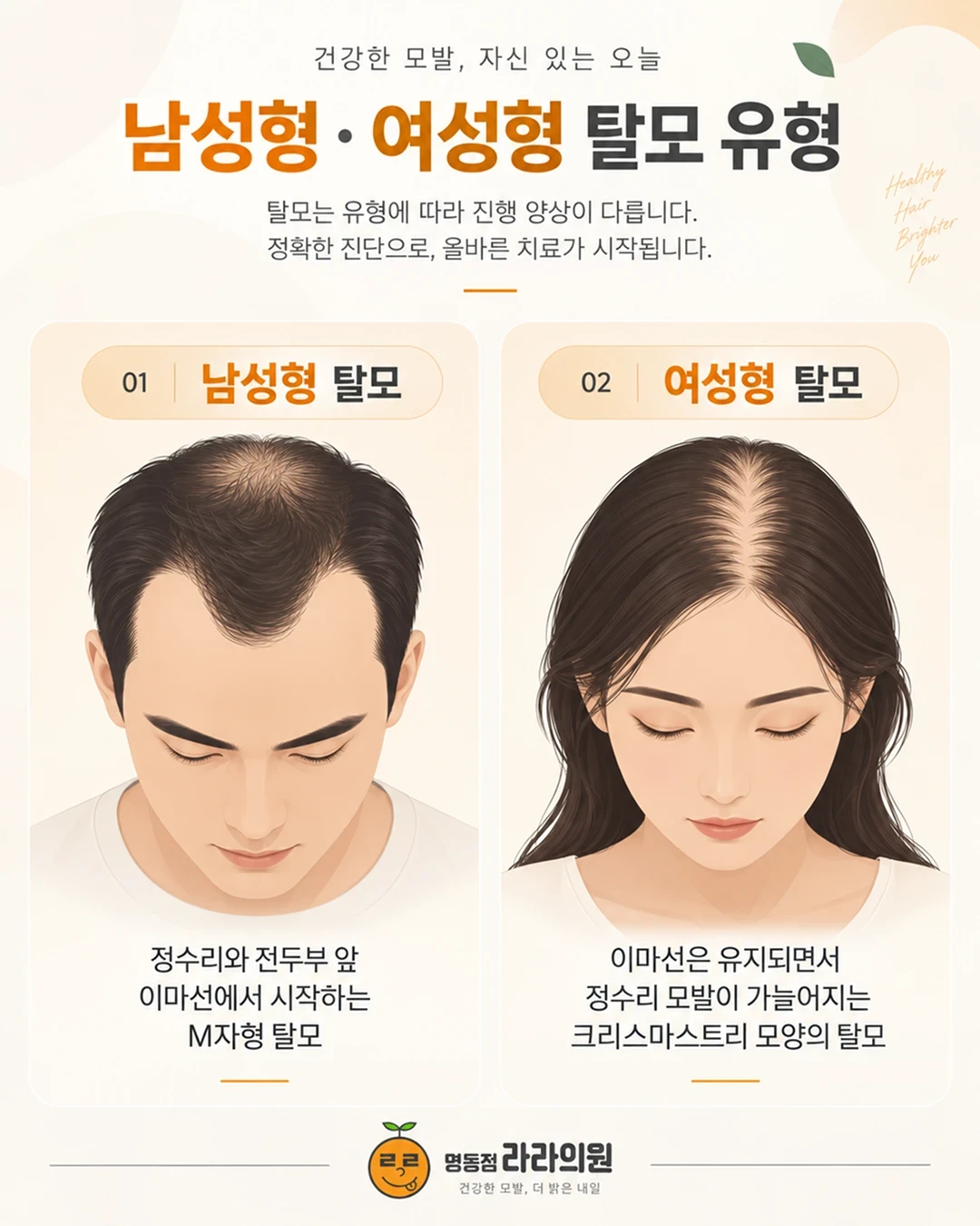 남성형·여성형 탈모 유형 비교 그림